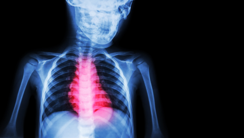 ischemic heart failure